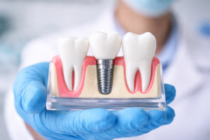 ABDC image Services Dental Implant