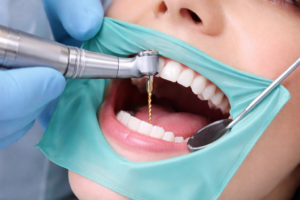 ABDC image Services root canal